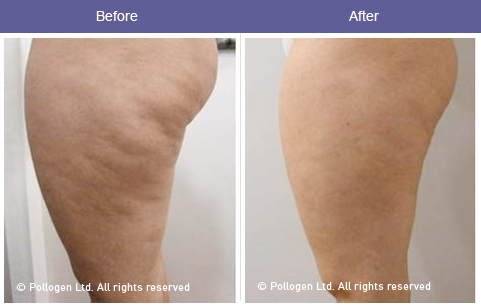 radiofrequência celulite antes e depois