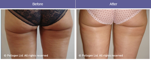 radiofrequência celulite antes e depois