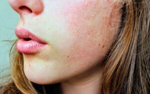 Acne emocional