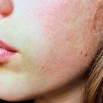 Acne emocional: como tratar