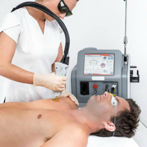 depilação laser masculina