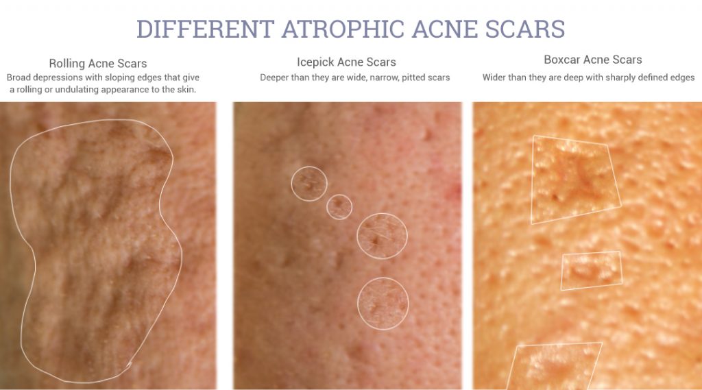 tipos de cicatrizes de acne