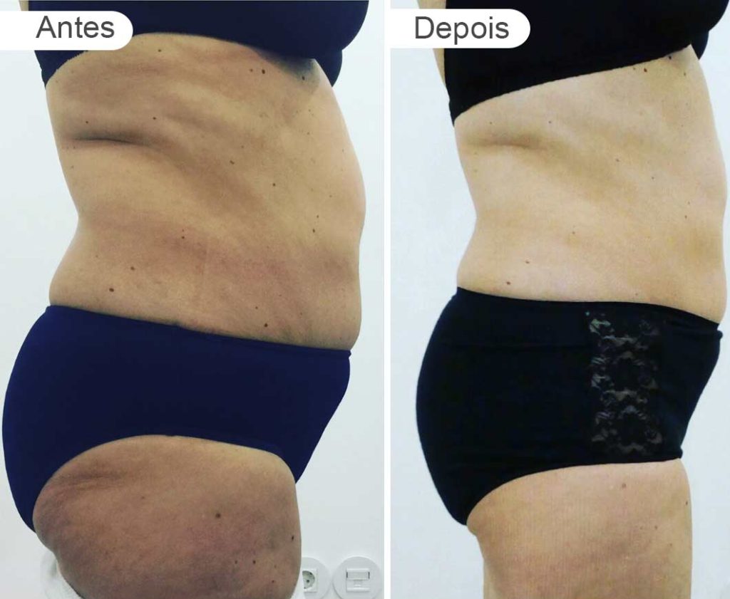 pagina resultados - antes e depois | barriga e rabo, lado