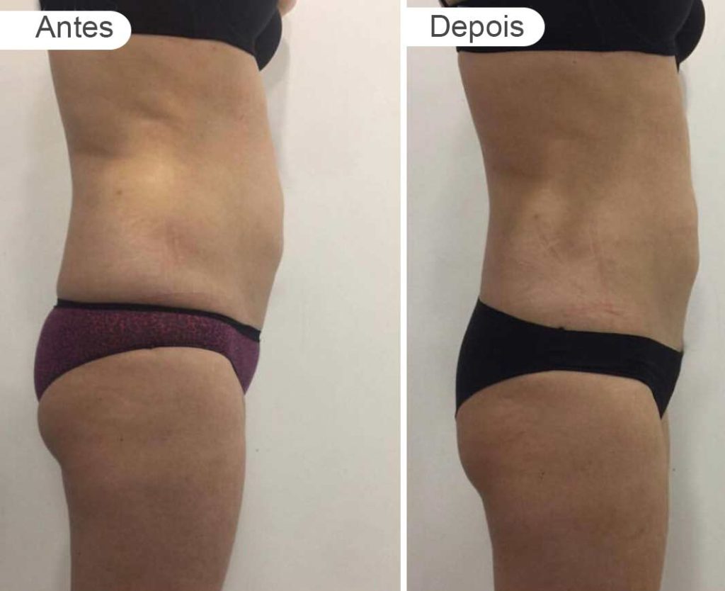 pagina-respagina resultados - antes e depois | barriga e rabo, lado, jovemultados-antes-e-depois-barriga-e-rabo-lado-jovem