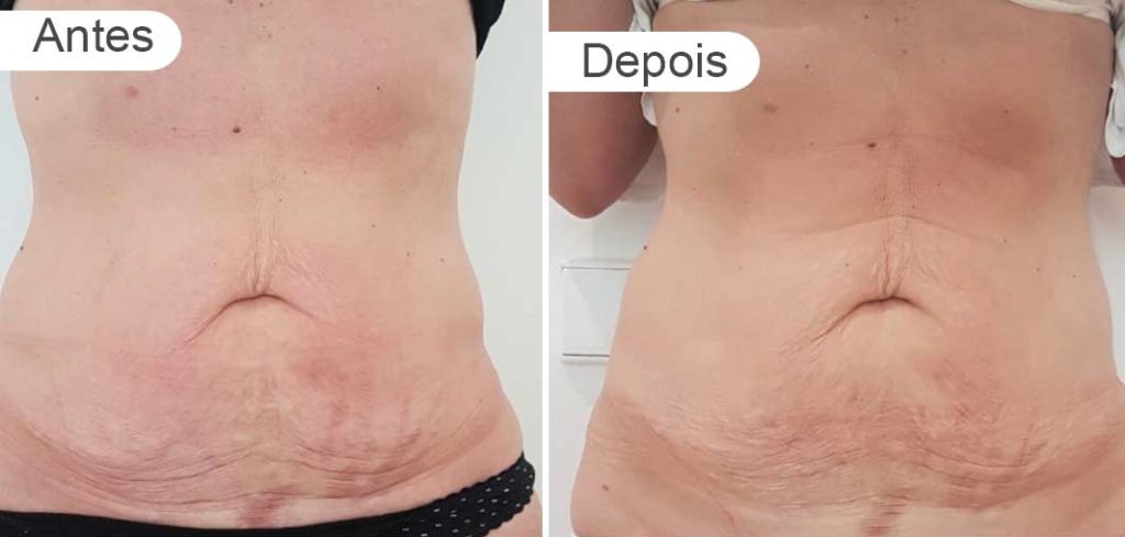 pagina resultados - antes e depois | barriga, frente