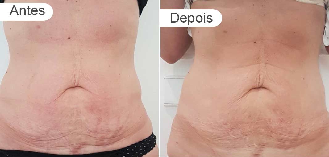 pagina resultados - antes e depois | barriga, frente