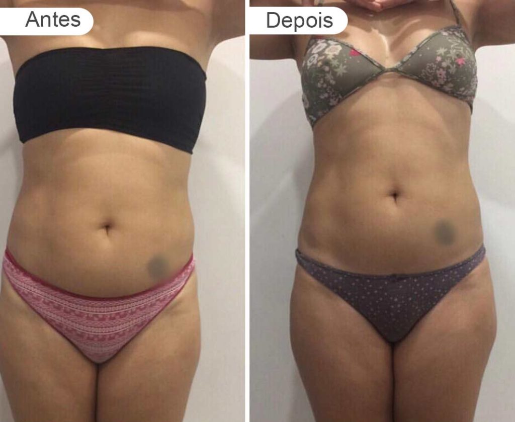 pagina resultados - antes e depois | barriga e rabo, frente, jovem