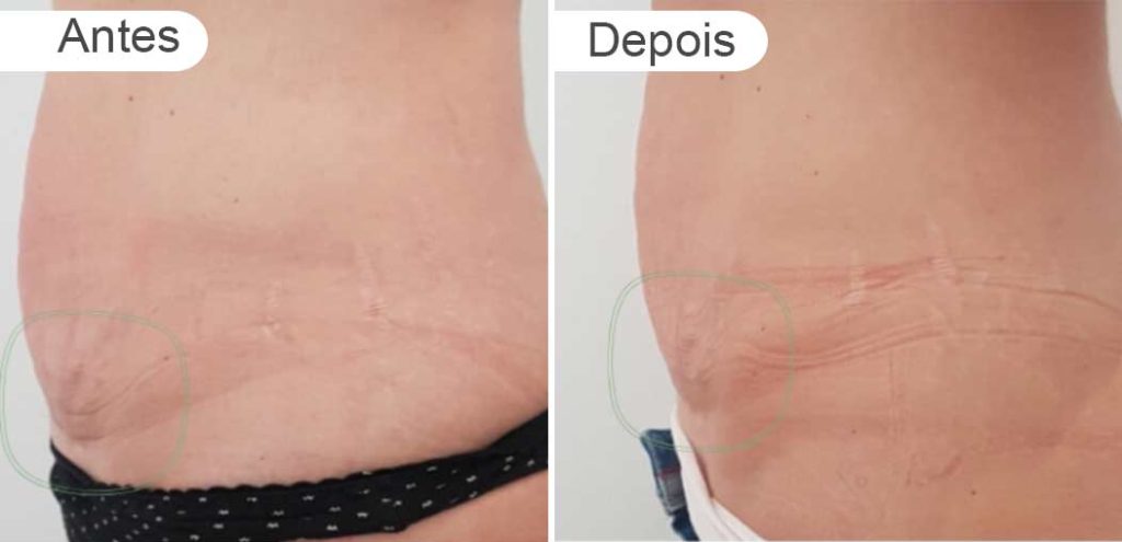 pagina resultados - antes e depois | barriga, lado
