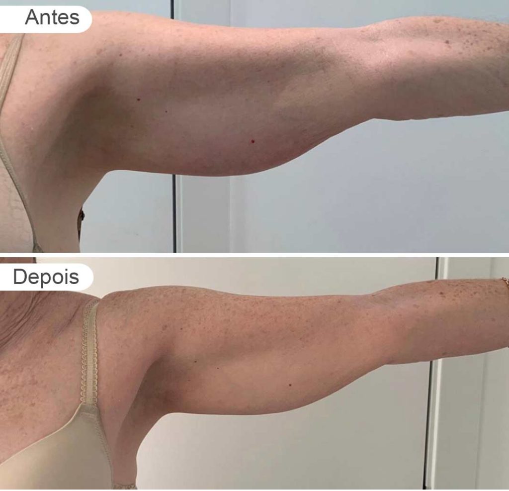 pagina resultados - antes e depois | braços