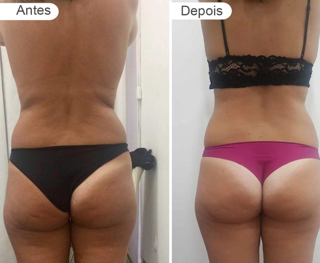 pagina resultados - antes e depois | rabo, costas