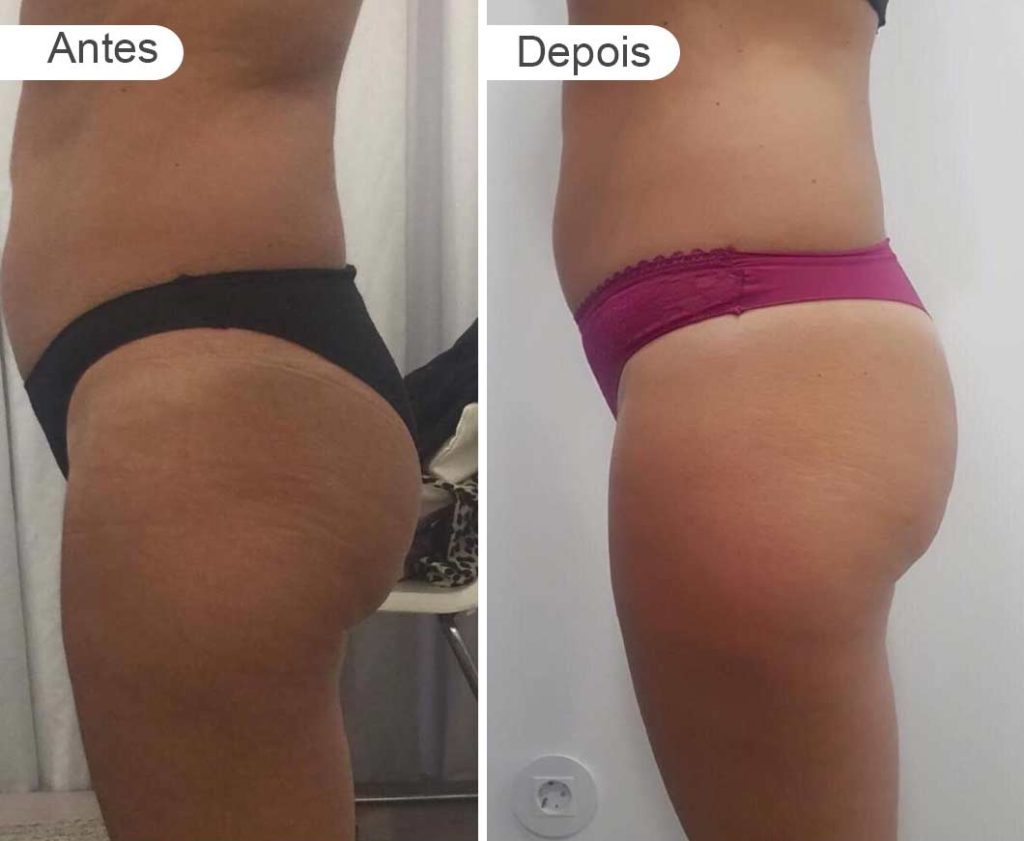 pagina resultados - antes e depois | rabo e pernas, lado