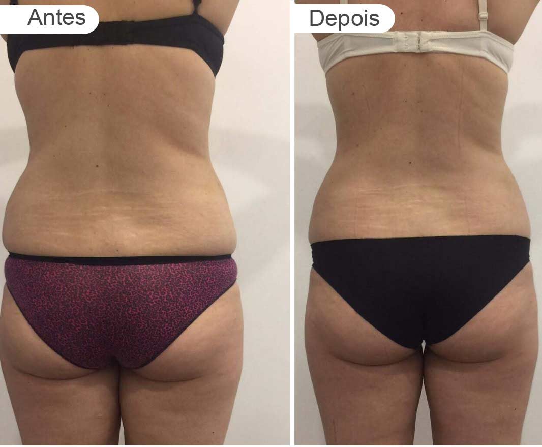 pagina resultados - antes e depois | rabo, costas