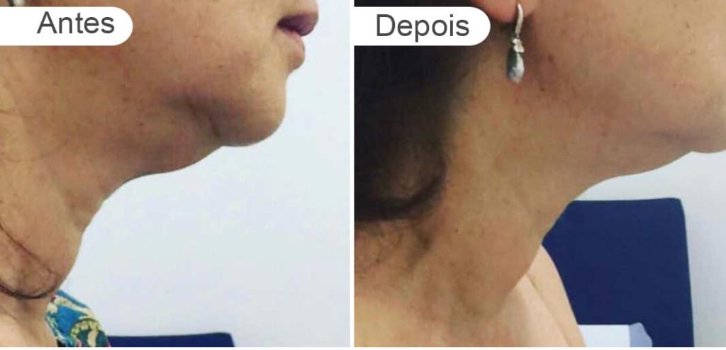 pagina resultados - antes e depois | pescoço