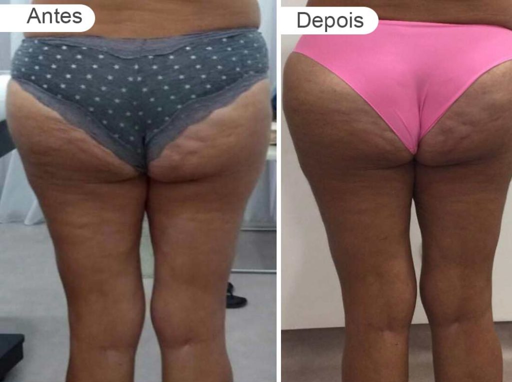 pagina resultados - antes e depois | rabo