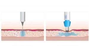intradermoterapia