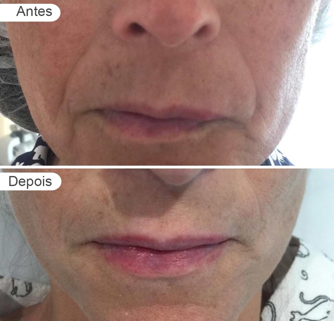 pagina de resultados: antes e depois, preenchimento, rosto frente mulher