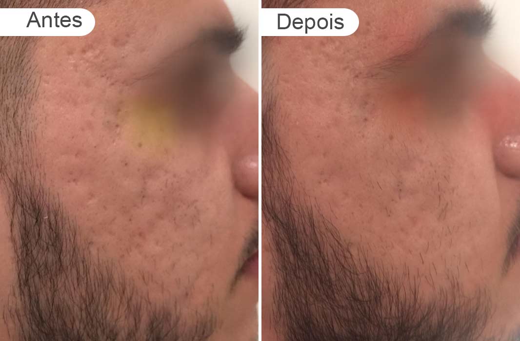 pagina de resultados: antes e depois rosto homem cicatriz ance, direito