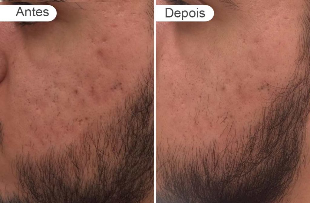 antes e depois rosto homem cicatriz ance, esquerdo