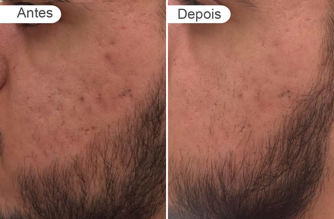 antes e depois rosto homem cicatriz ance, esquerdo