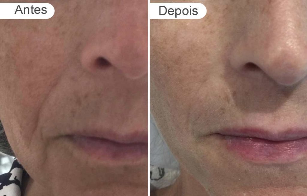 pagina de resultados: antes e depois, preenchimento, rosto de mulher - detalhe
