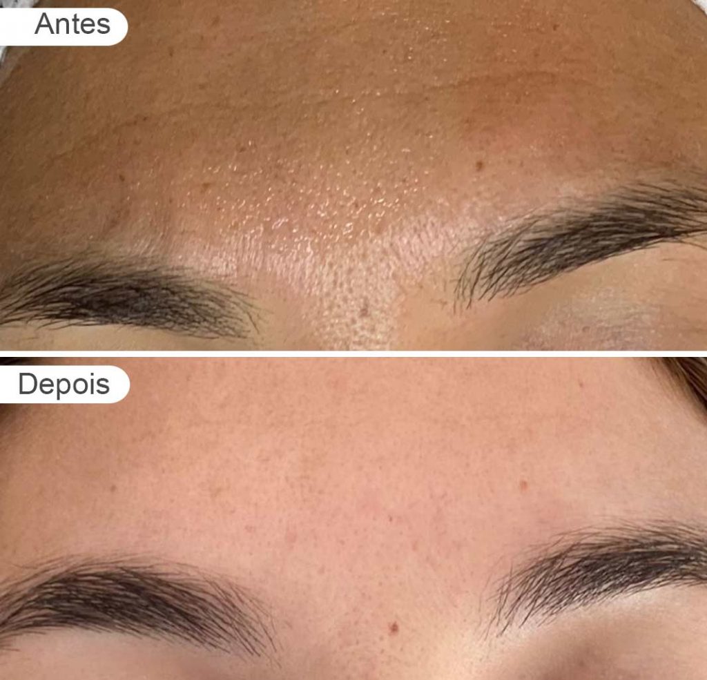 pagina de resultados: antes e depois, rugas