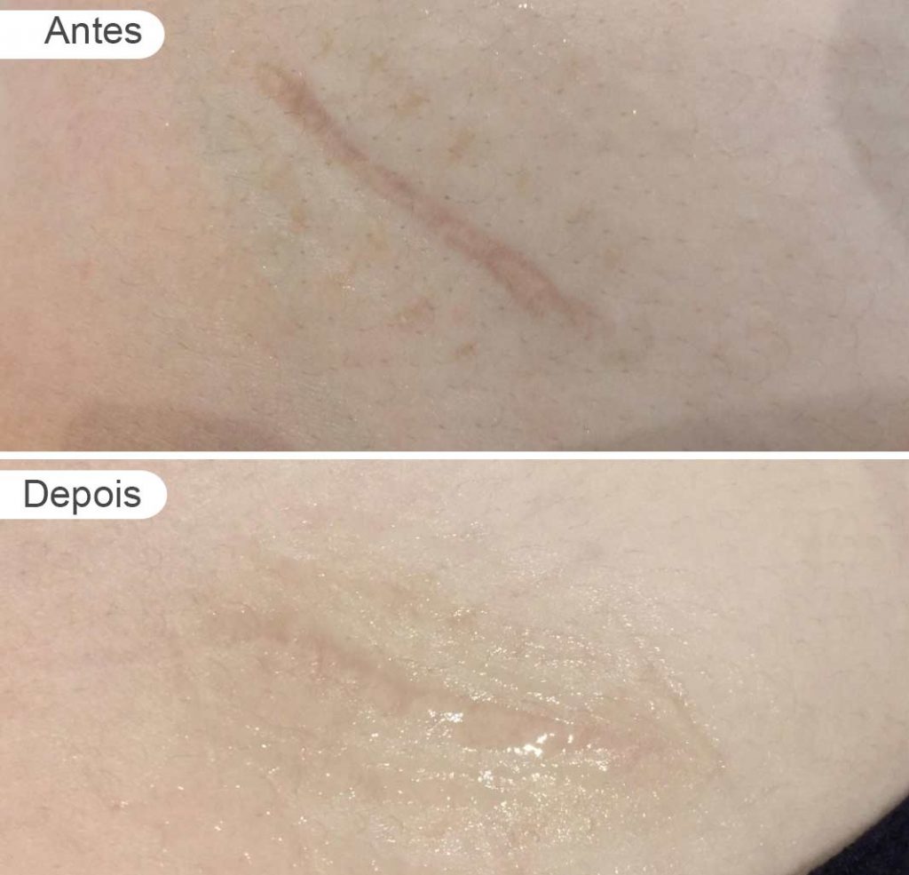 pagina-resultados-antes-e-depois-Reducao-de-cicatriz-de-apendicite-1024x985