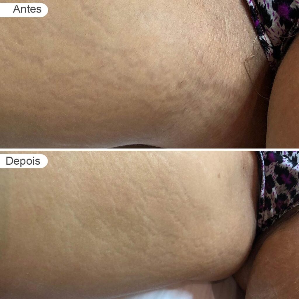 Estrias | antes e depois
